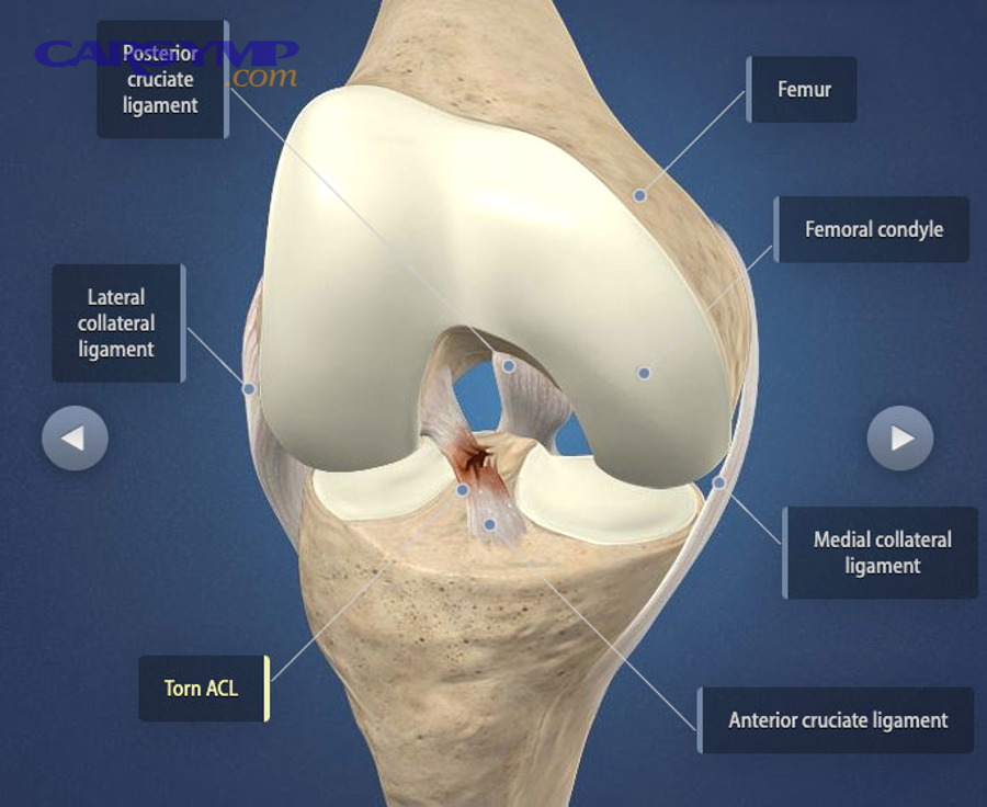 Thermostat housing and bleeder screw location highlighted in an engine bay photo