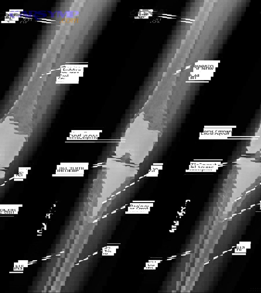 swelling reduction timeline showing progressive improvement after joint replacement